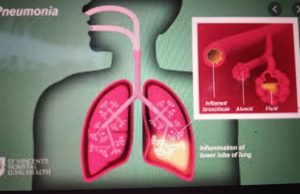 Hosi Vizilansia Sentinela COVID-19, Halo Analize Mos Ba Sintomas Respiratorius