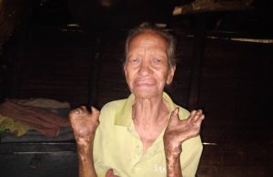 Clementina Sofre Moras Lepra Durante Tinan 48 iha Laclubar, Moris Iha Area Rural Halo nia Mukit Liutan